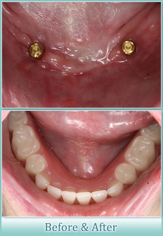 Before And After Dentures Iron River WI 54847